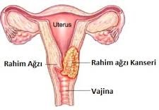 rahim-agzi-kanseri-hpv-asisi